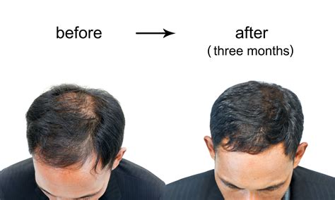 Men's Hair Loss Causes & Treatments .